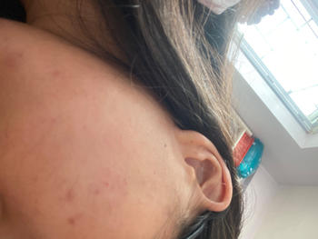aprilskin.com.sg Carrotene Pimple Stopper Review