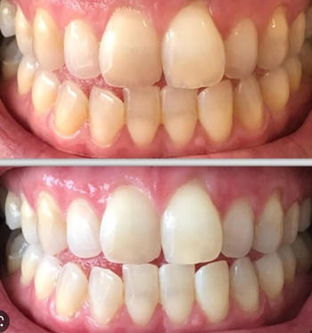 Smilie Boost Teeth Whitening Kit