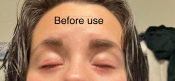 The Eczema Company Organic Manuka Skin Soothing Cream by YoRo Naturals Review