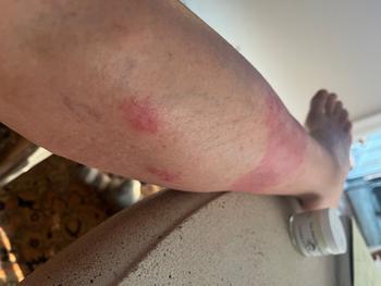The Eczema Company Grass Fed Tallow Balm Review