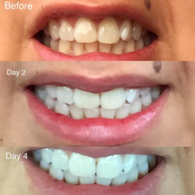Teeth Whitening Kit Purelywhite Deluxe