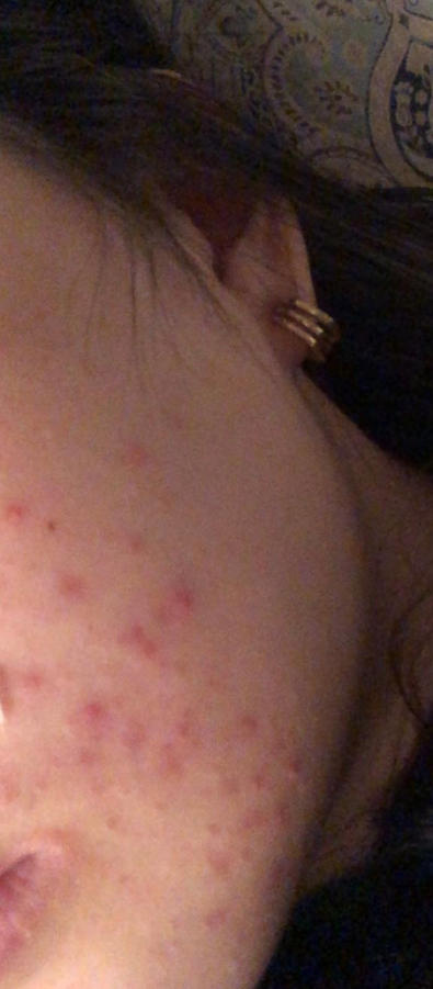 Red Foam Cleanser - Customer Photo From Jamie