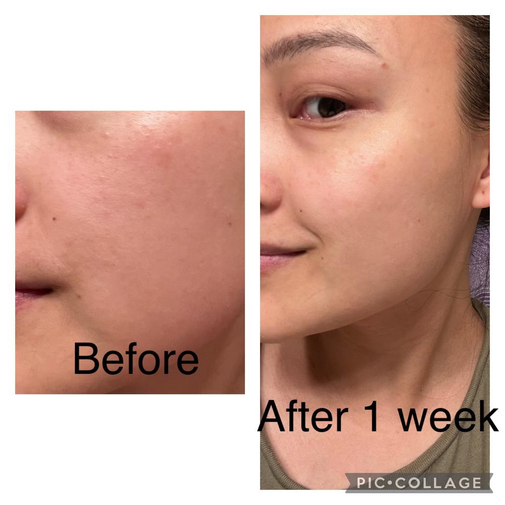 Carrotene Trouble-Free Kit (with FREE Minis!) - Customer Photo From Kao Vang