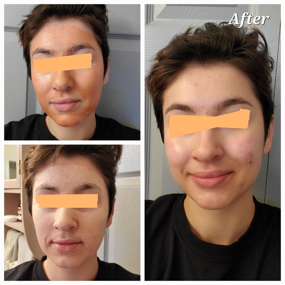 Carrotene IPMP™ Quick Dry Pore Tightening Clay Mask - Customer Photo From Catalina
