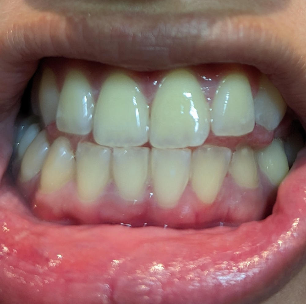 2-Pen Holo Teeth Whitening Kit - Customer Photo From Camille S.