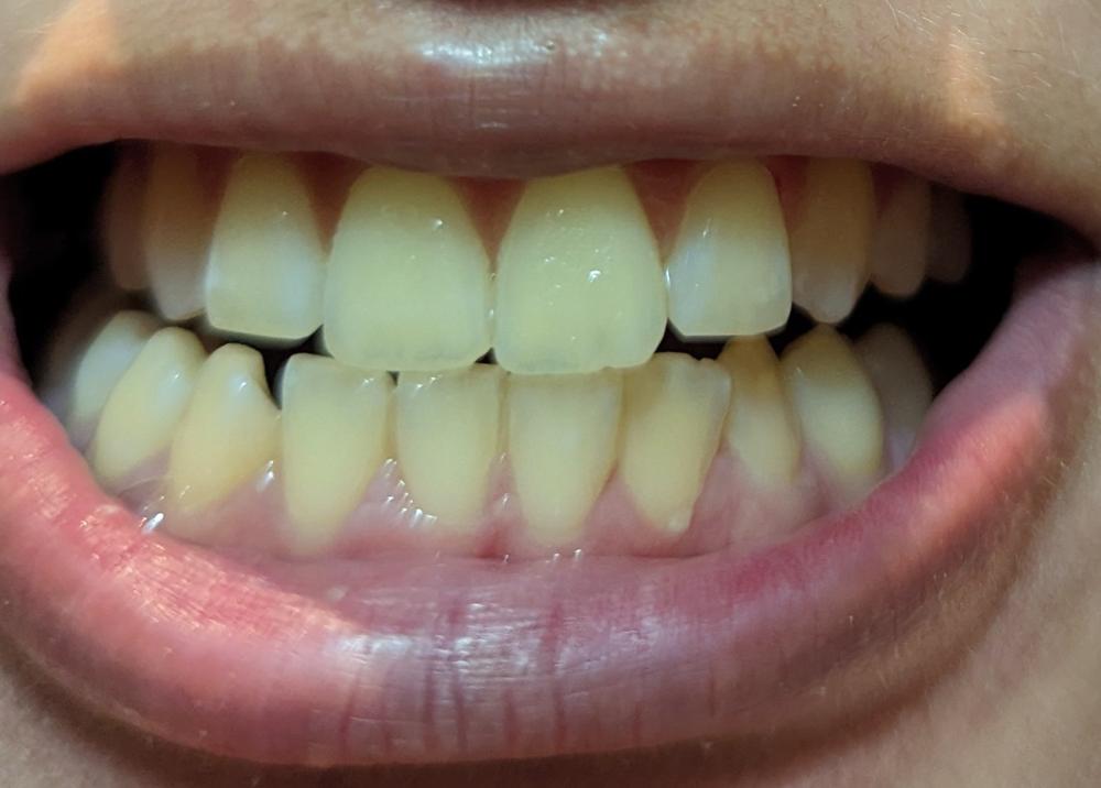 2-Pen Holo Teeth Whitening Kit - Customer Photo From Camille S.