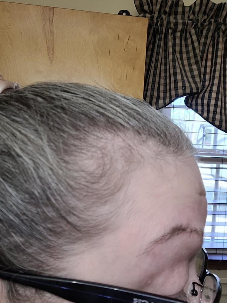 Intensive Hair Growth Drops - 3 Month - Customer Photo From Patti Lane