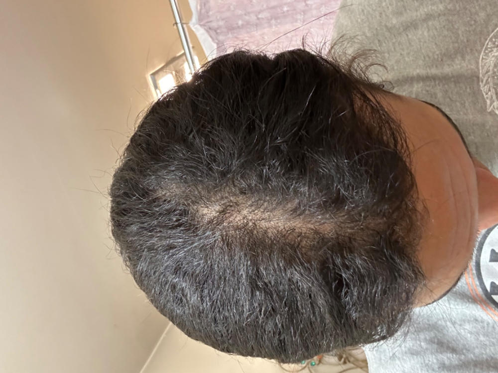 REVIVE DHT Blocker Formula - Customer Photo From Alex Diaz