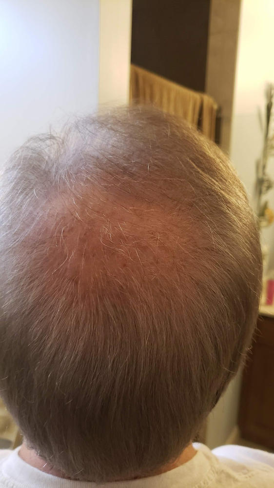 3-in-1 Hair Growth Formula - Customer Photo From David Manegre