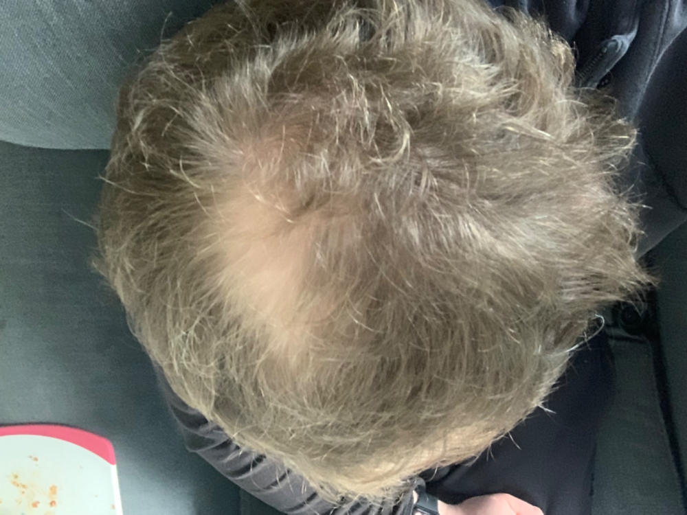 3-in-1 Hair Growth Formula - Customer Photo From Blair Rooney