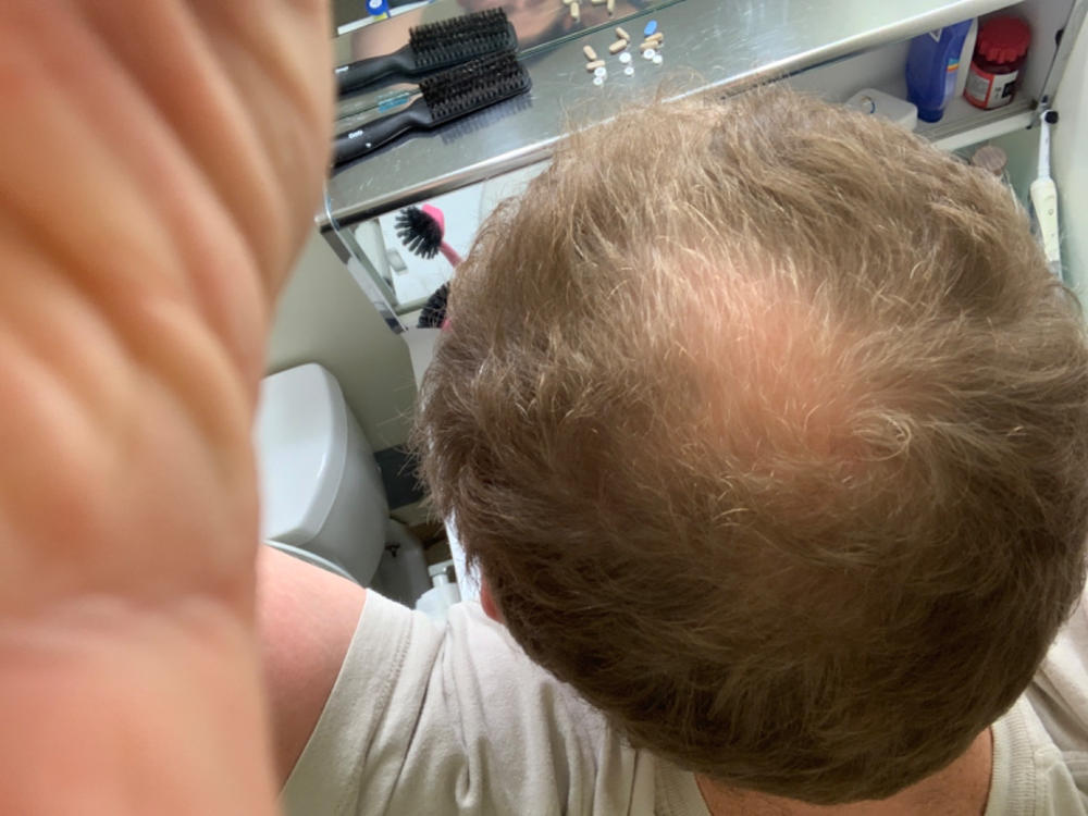 3-in-1 Hair Growth Formula - Customer Photo From Blair Rooney