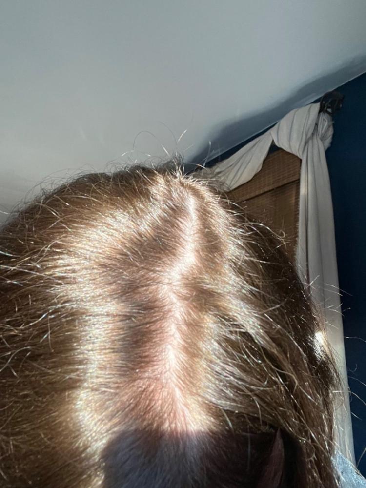 3-in-1 Hair Growth Formula - Customer Photo From Michele Cappellett