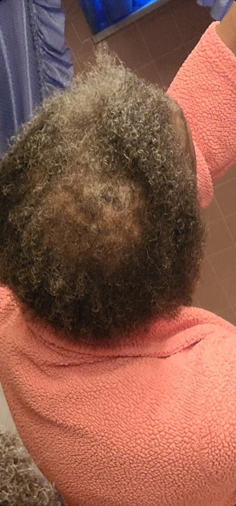 Anti-Hair Loss Serum - Customer Photo From Michele London