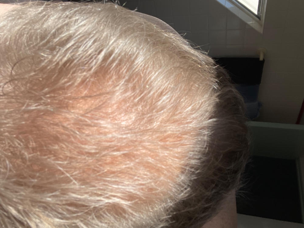 Anti-Hair Loss Shampoo - Customer Photo From Daniel Takacs