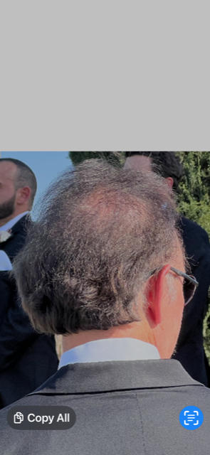 TruVarin Enriched Hair Growth Formula - Customer Photo From Kenneth Steinbach