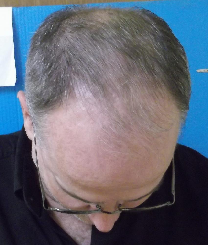 TruVarin Enriched Hair Growth Formula - Customer Photo From Ted