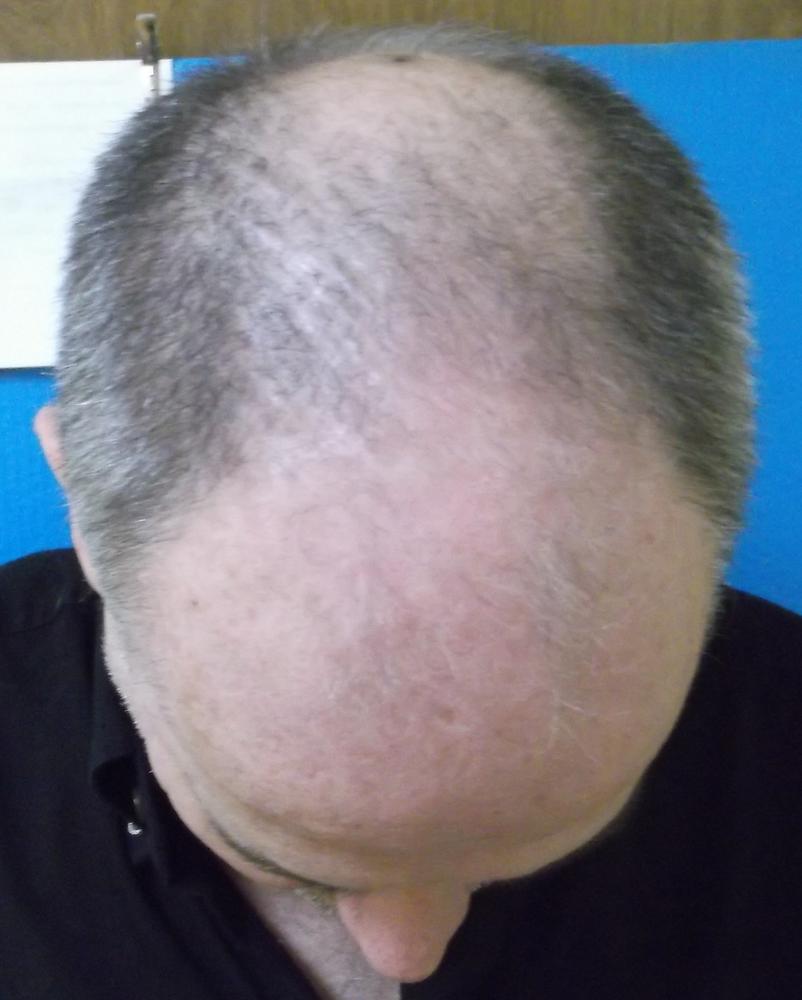 TruVarin Enriched Hair Growth Formula - Customer Photo From Ted