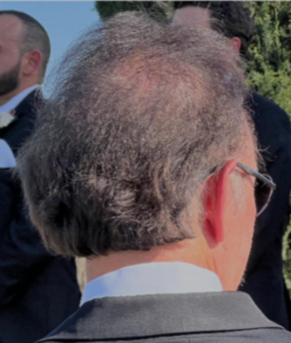 TruVarin Enriched Hair Growth Formula - Customer Photo From Kenneth