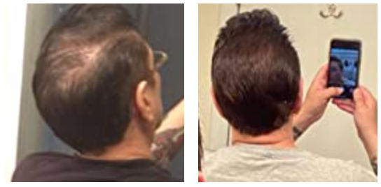 TruVarin Enriched Hair Growth Formula - Customer Photo From Dough