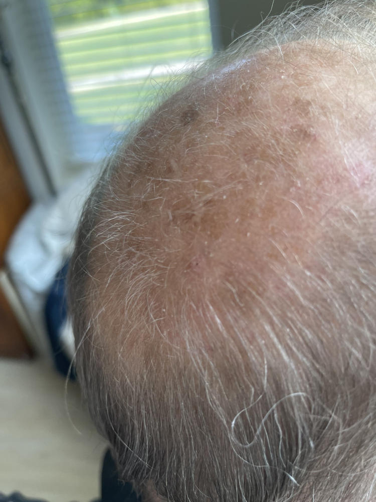 TruVarin Enriched Hair Growth Formula - Customer Photo From Joe Kinchen