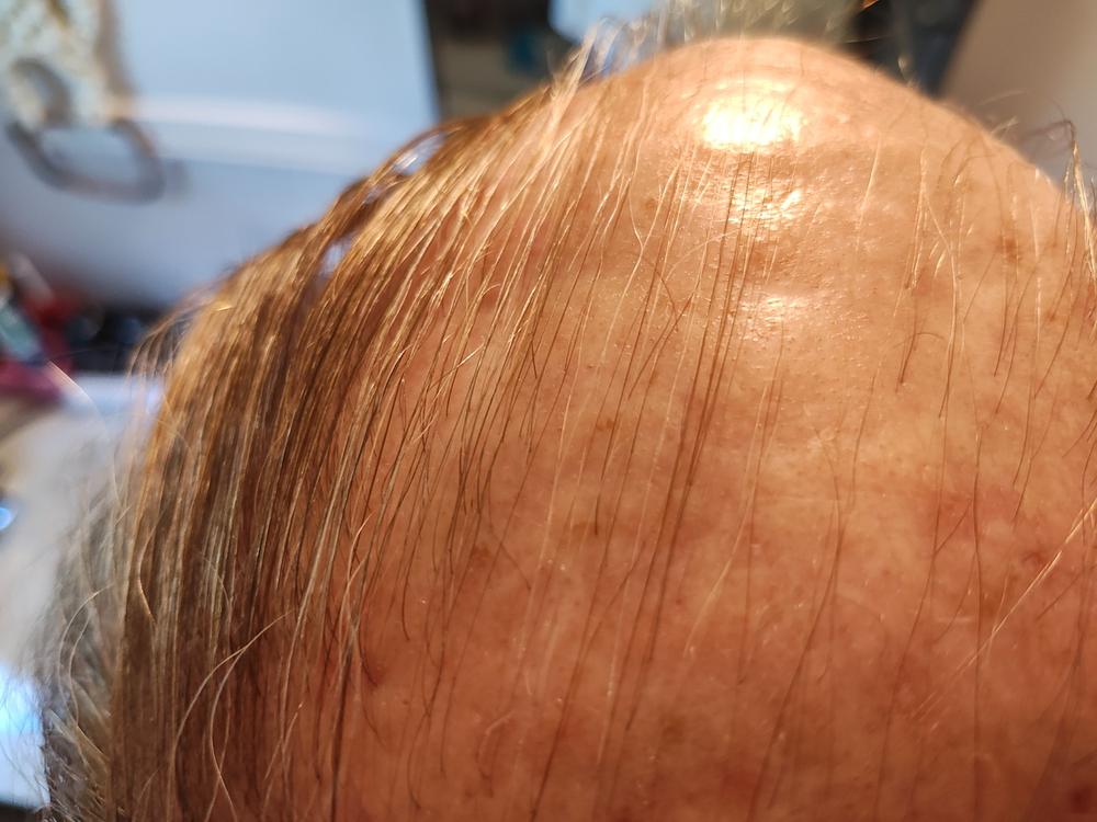 TruVarin Enriched Hair Growth Formula - Customer Photo From Fred Jones