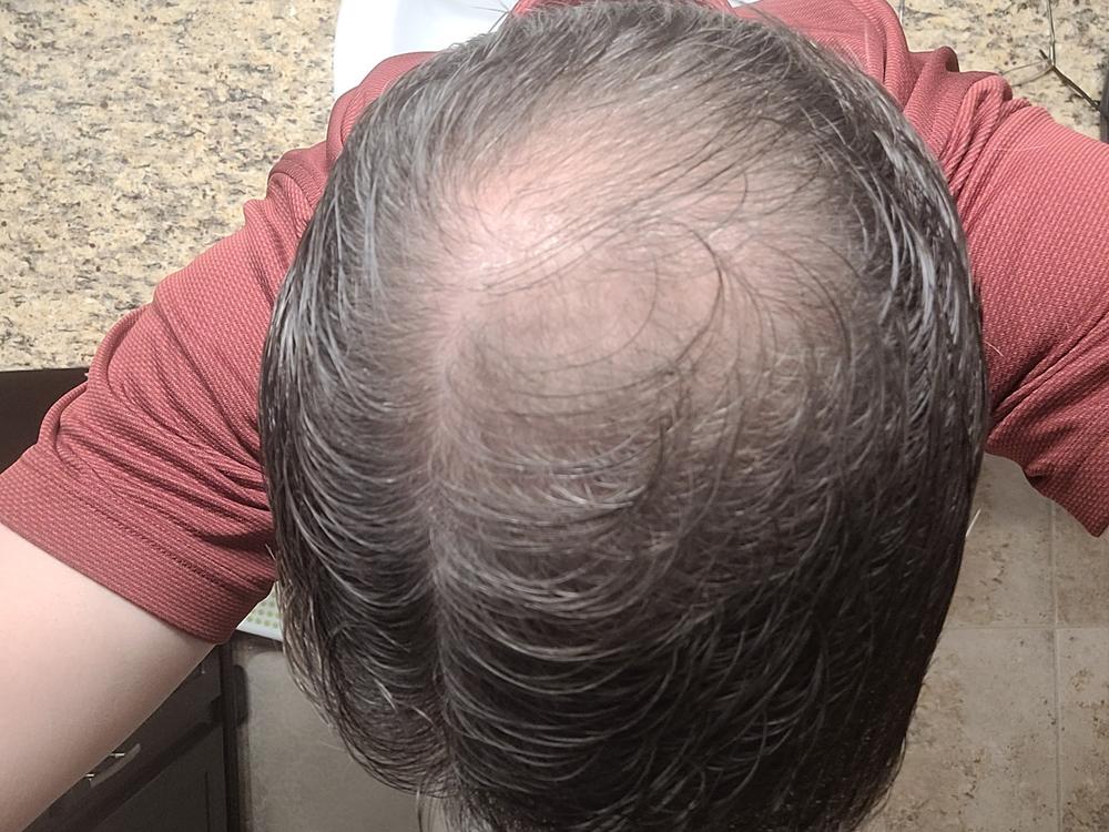 GROW MY HAIR (Hair Growth Supplement) FOR MEN - Customer Photo From CHARLES LAUBACH