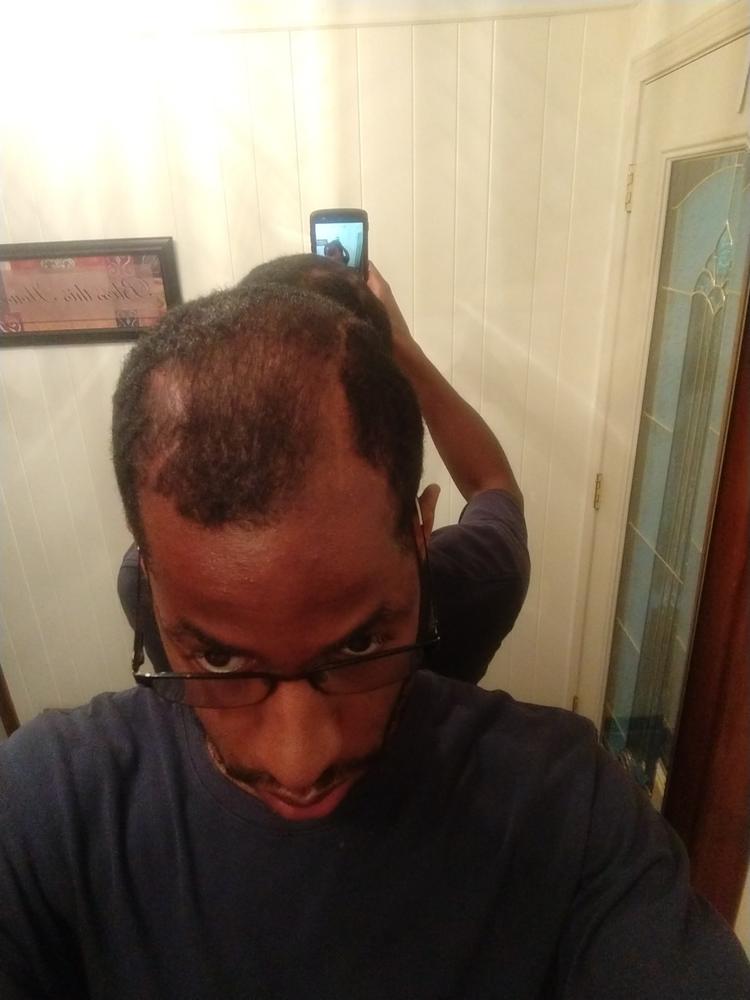 GROW MY HAIR (Hair Growth Supplement) FOR MEN - Customer Photo From WILLIAM G.