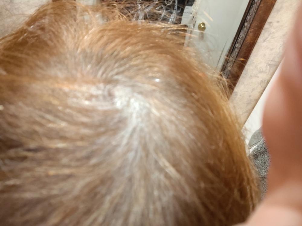 PATENTED HAIR REGROWTH SYSTEM FOR WOMEN - Customer Photo From Debra Allison