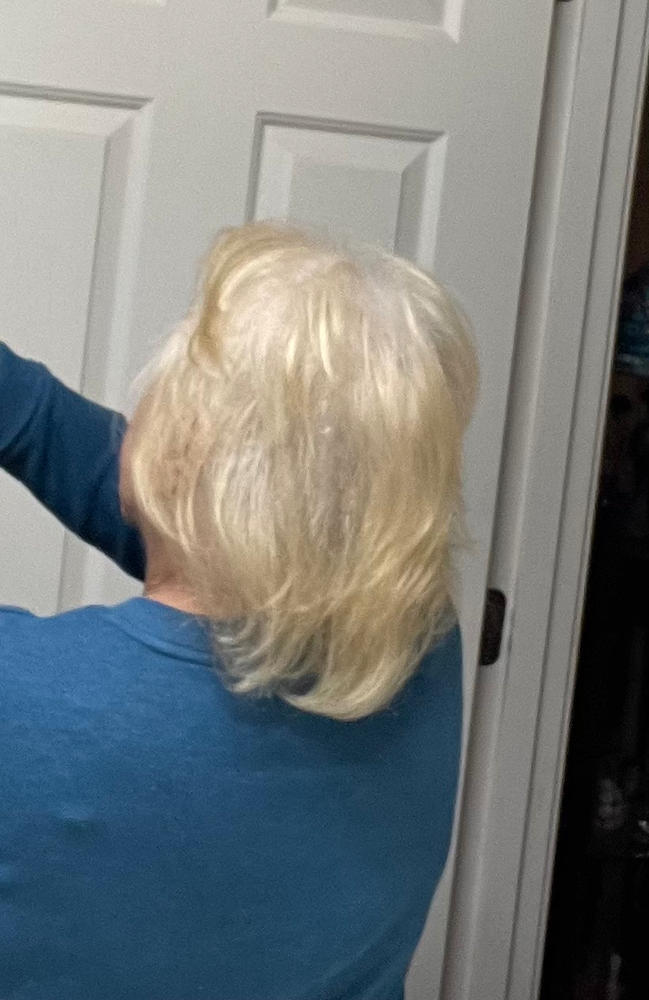 PATENTED HAIR REGROWTH SYSTEM FOR WOMEN - Customer Photo From Therese Garner