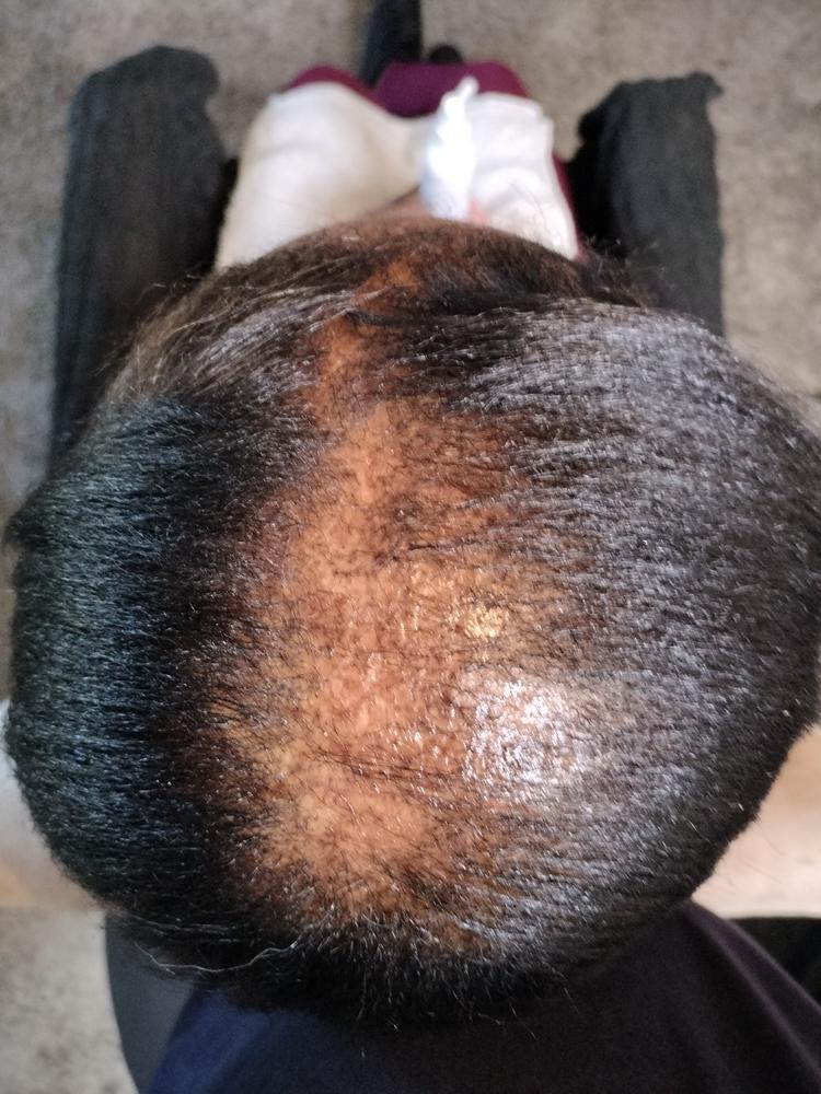 PATENTED HAIR REGROWTH SYSTEM FOR WOMEN - Customer Photo From Suzette Scott