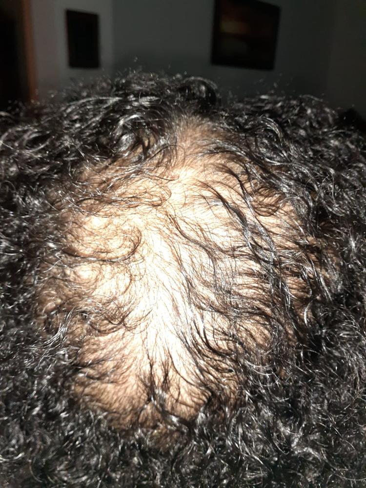 ScalpMED® Essentials (Hair Care Essentials Kit) - Customer Photo From Rodlaine D.