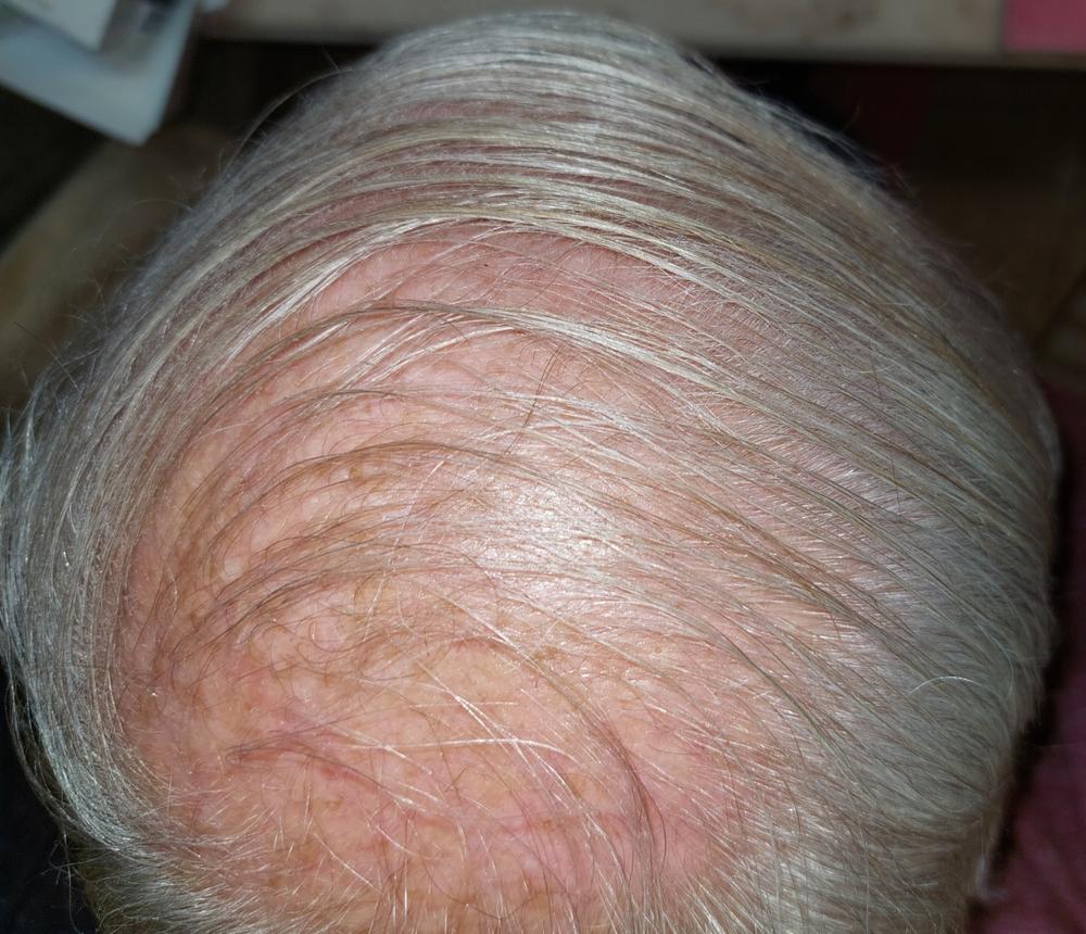 PATENTED HAIR REGROWTH SYSTEM FOR MEN - Customer Photo From Rick Mayers