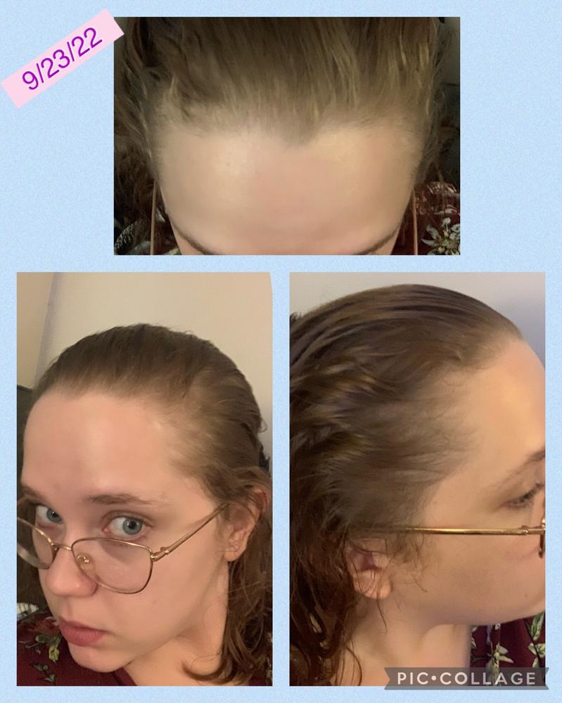 Hair Growth Serum - Customer Photo From Jaime W