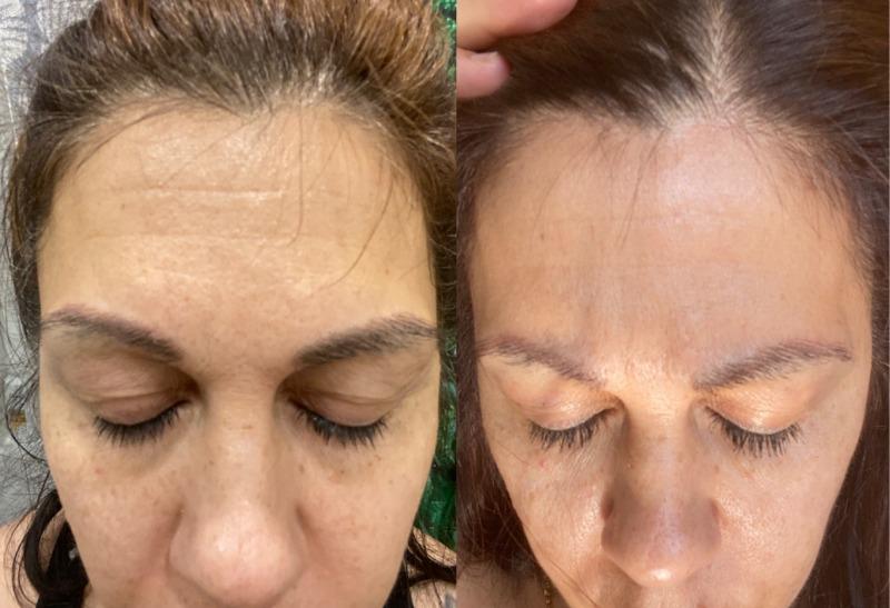 varinha de cuidados com a pele de renovação radiante 4 em 1 e kit de soro ativador - foto do cliente de Marilyn Latulippe