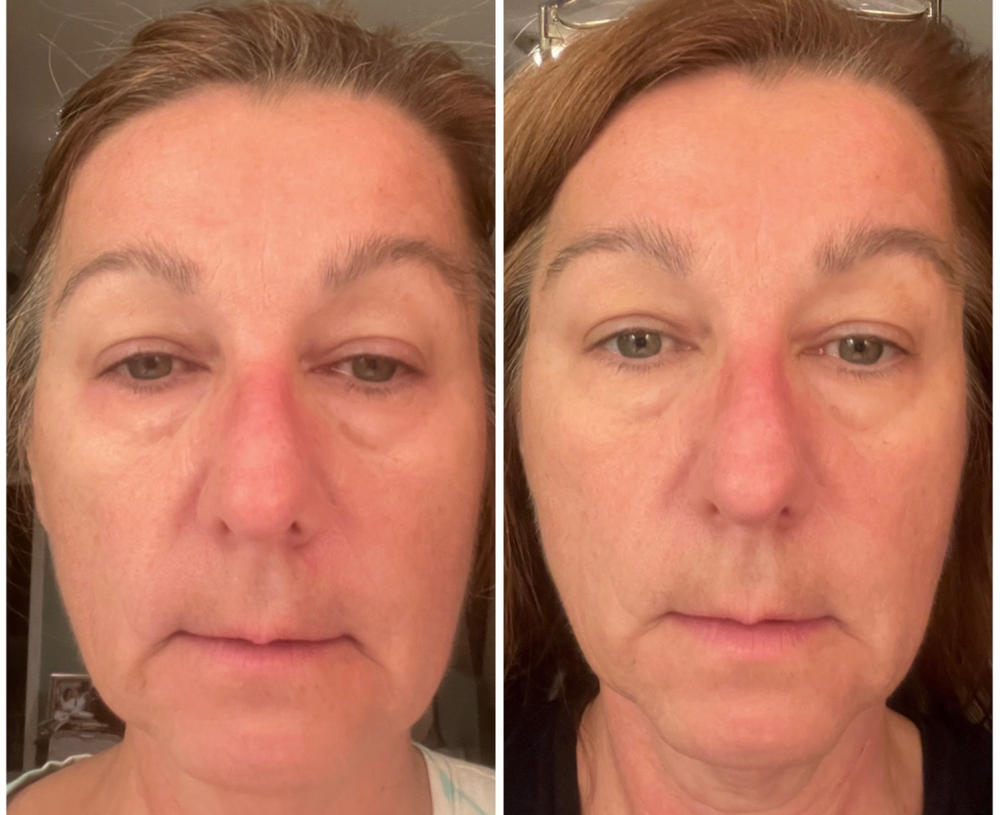 4-in-1 Red Light Therapy Skincare Wand & Activating Serum Kit - Customer Photo From Jennifer L.