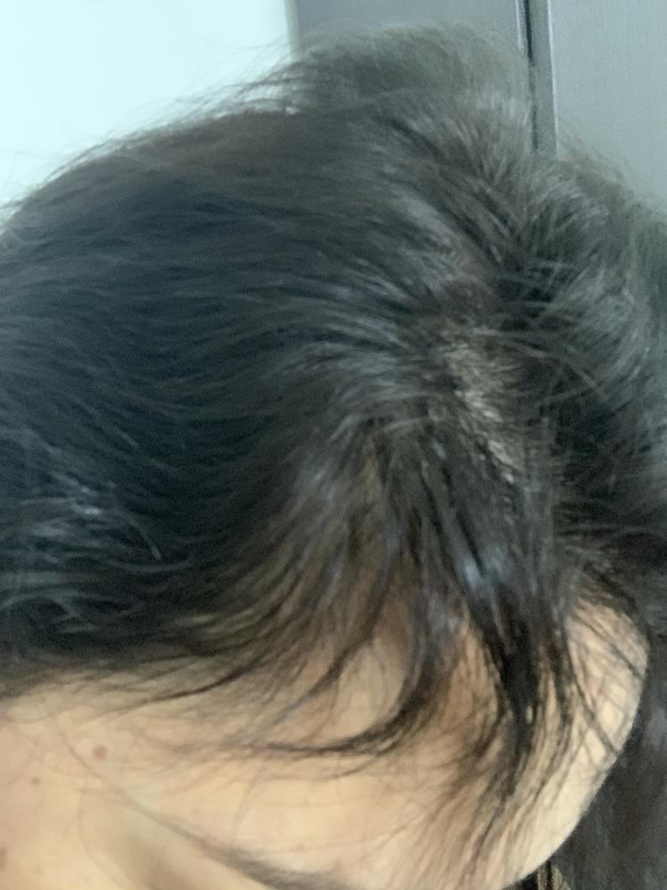 Spectral.RS® | Tratamiento para el adelgazamiento y pérdida difusa del cabello - Customer Photo From Monica P.