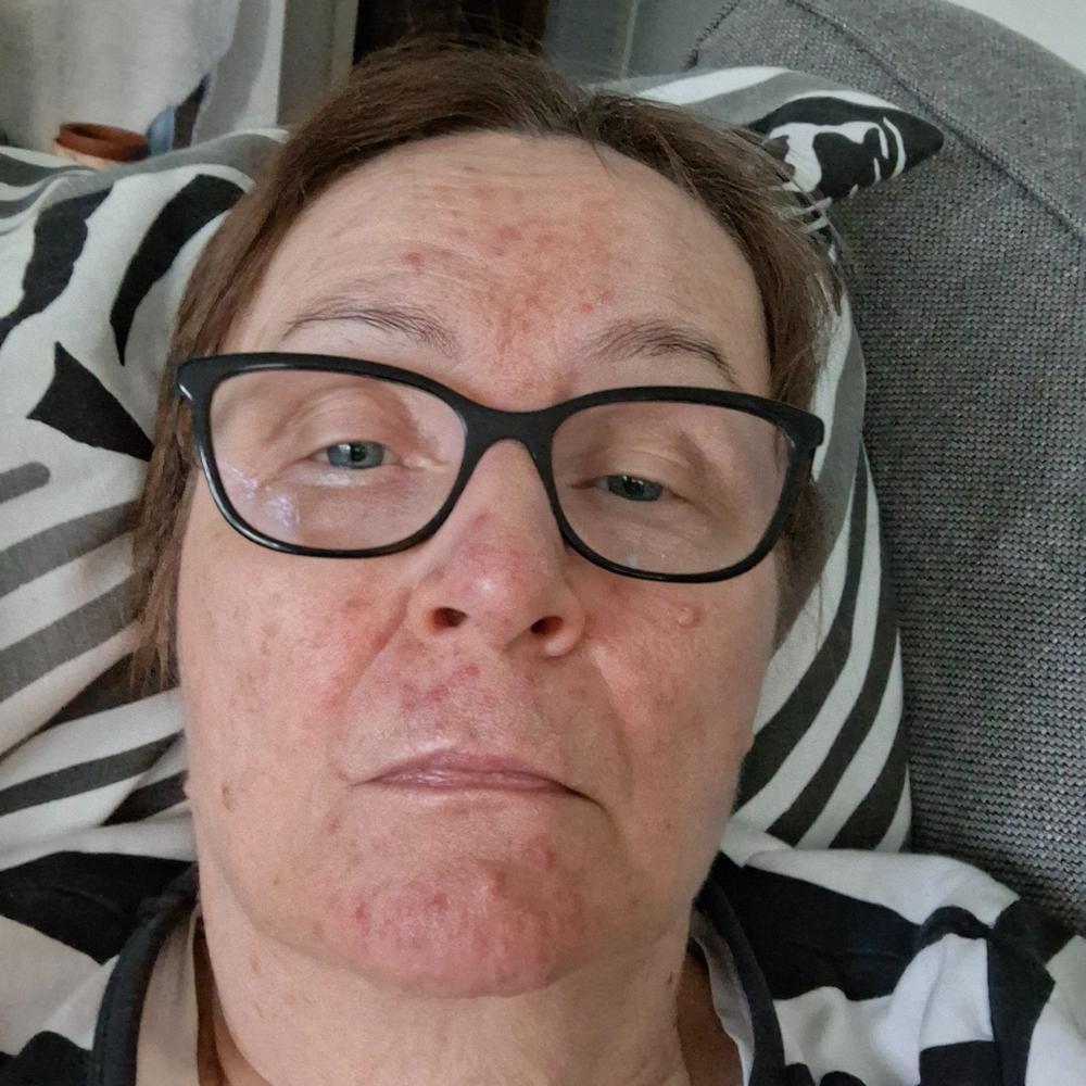 Teepuusaippua, atooppiselle, kutisevalle ja akneiholle, kaikille ihotyypeille, vegaaninen, 100% luonnollinen - Customer Photo From Ritva H.