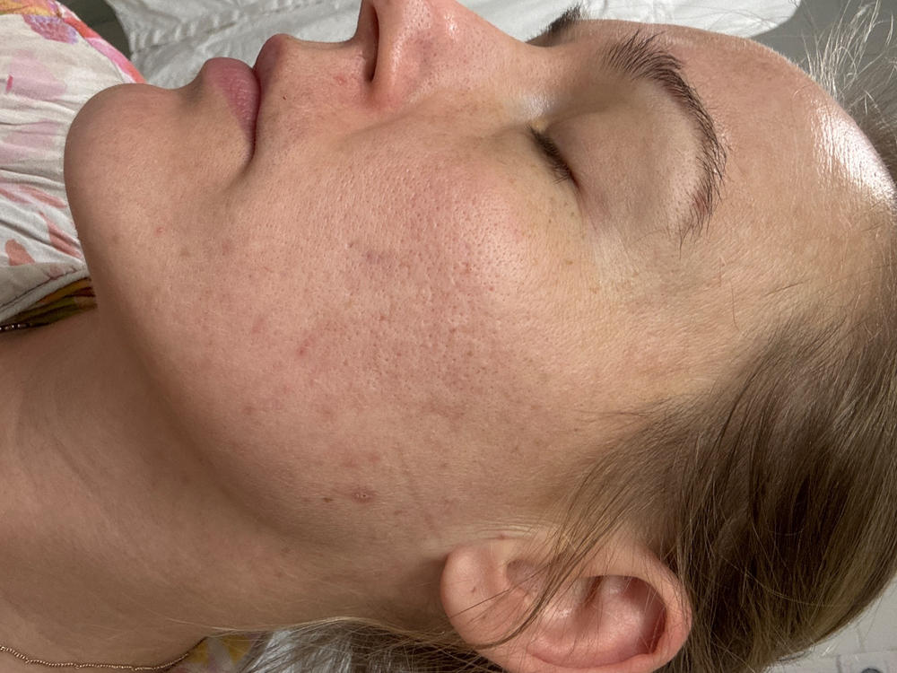 Veera Suolasaippua®, sopii mm. atooppiselle iholle, kutiavalle iholle, akneiholle, 100% luonnollista, vegaaninen - Customer Photo From Annmarie Åstrand