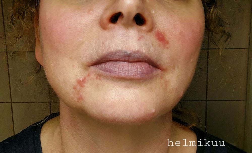 Saariston Suolasaippua®, sopii psoriasis iholle, atooppiselle ja ekseema iholle, hajusteeton, 100% luonnollista - Customer Photo From Kirsi Kirjakainen