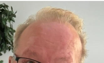 Tyrni kehäkukka shampoo, hiustenlähtöön, kutisevalle ja hilseilevälle päänahalle, sulfaatiton, 94% luonnollista, vegaaninen - Customer Photo From Virpi Moilanen