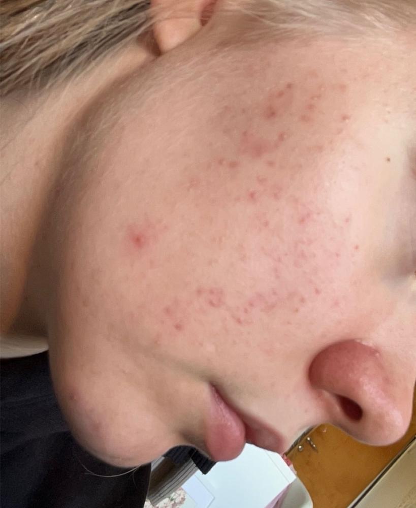 Nestemäinen Teepuusaippua pumppupullossa, erityisesti akneiholle, kaikille ihotyypeille, sulfaatiton, 95% luonnollista, vegaaninen, 200ml - Customer Photo From Ellen W.