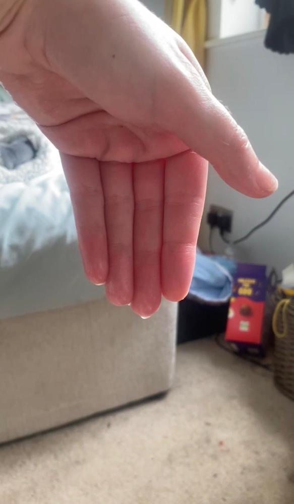 Iontophoresis Machine for Hyperhidrosis | Dermadry