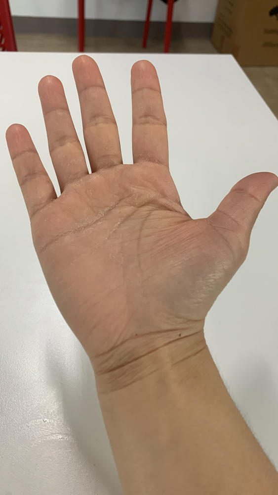 Dermadry — Treat excessive sweating — Iontophoresis Machine