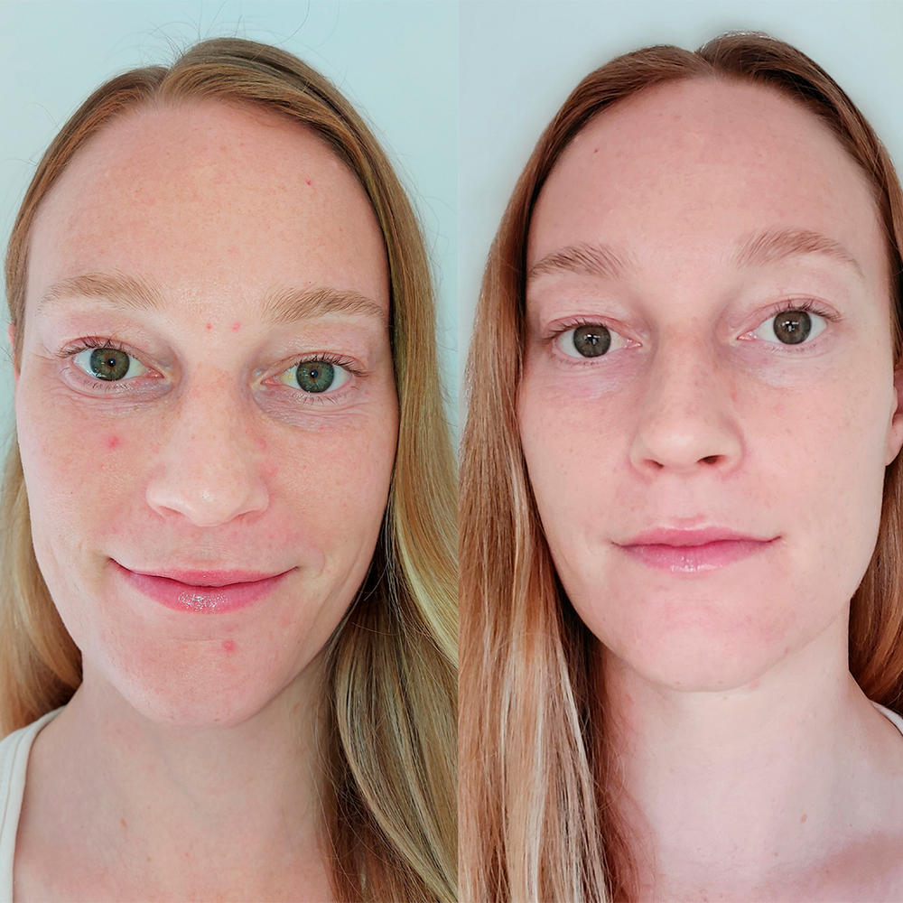 Salicylic Foaming Face Cleanser - Customer Photo From Jennifer G.