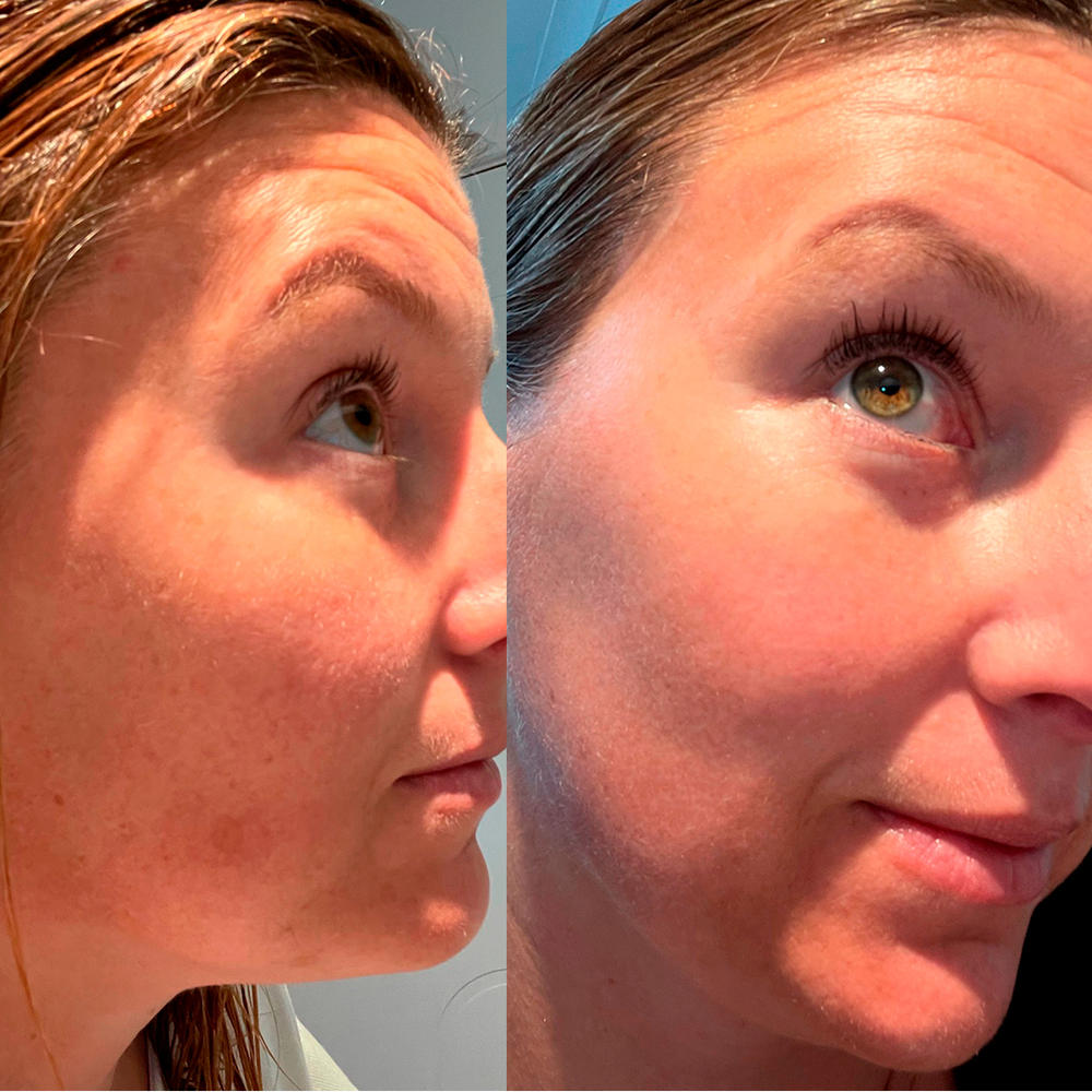 Salicylic Foaming Face Cleanser - Customer Photo From Janelle R.