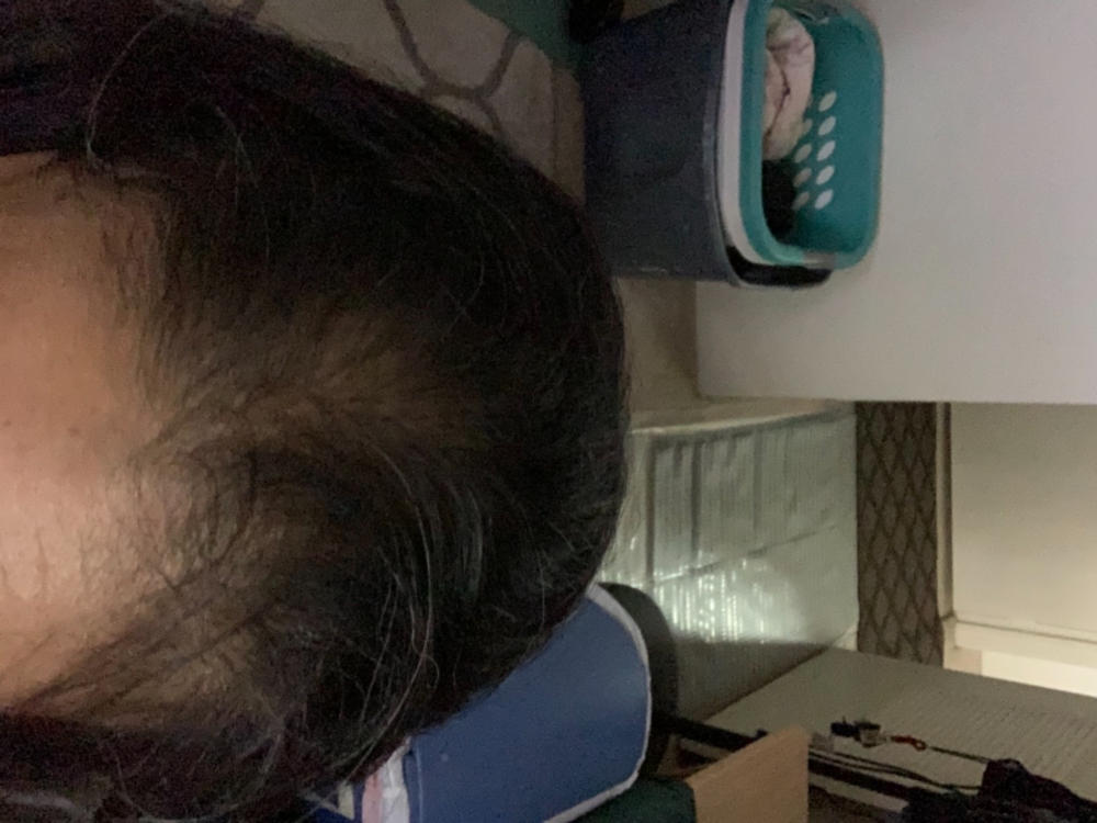 Hair Regrowth Treatment FDA Approved Keranique