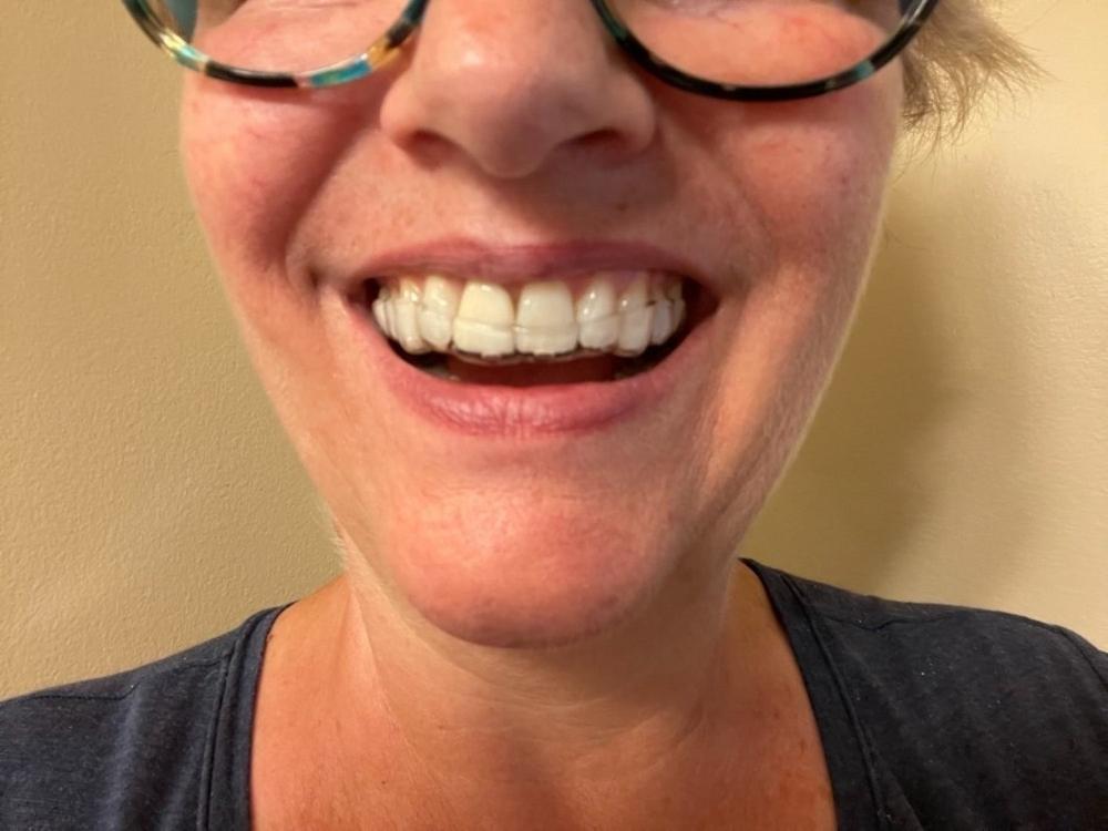 Single Layer Hard - Customer Photo From Dale Sturgess