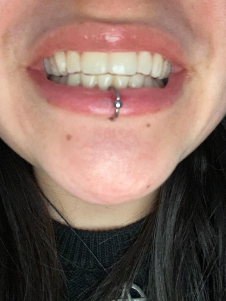 Essix Retainer 1mm - Customer Photo From Paula Andrea Hernandez Coral