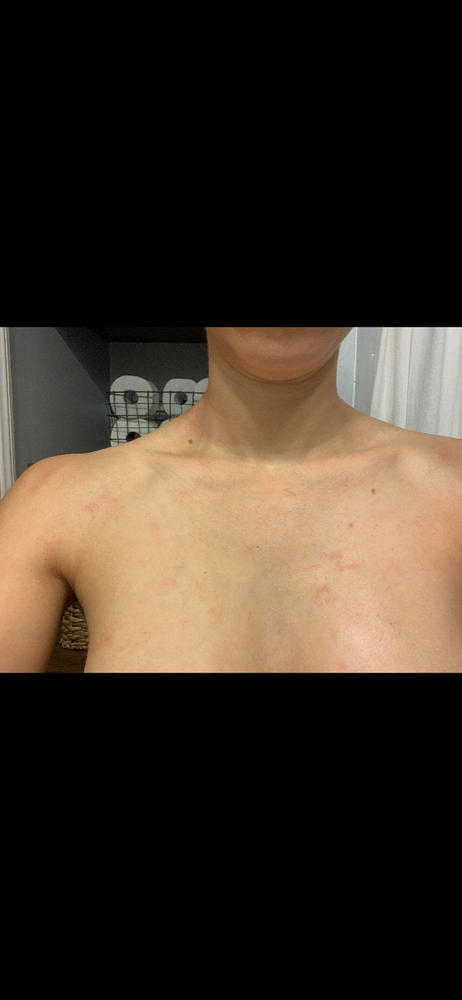 Eczema Formula - Customer Photo From Maryceleste Hernandez