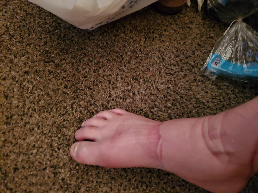 Soft AFO Drop Foot Brace | Shoe Dorsiflexion Assist for Neuropathy or Charcot Marie Tooth Treatment - Customer Photo From Lisa Spurgeon 
